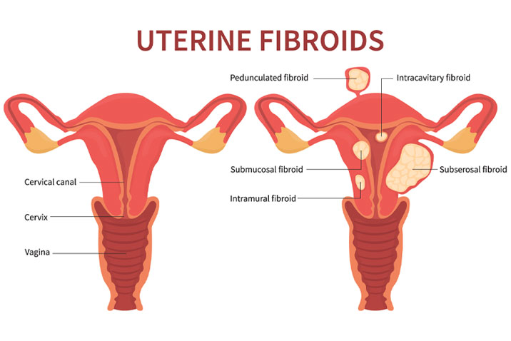 Fibroids and infertility: There is a solution